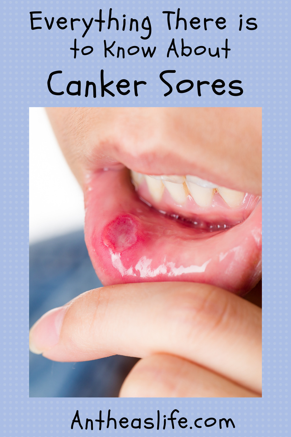 everything-there-is-to-know-about-canker-sores