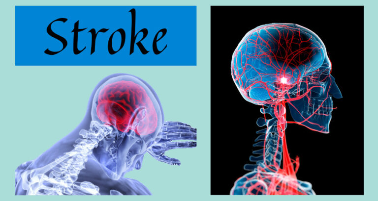 5 Tell-tale Signs You Are Having a Stroke